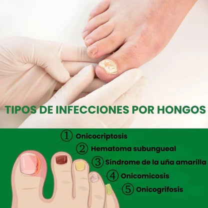 👋🦠Anti Hongos Uñas - German Toenail Plus™  2UND 30ml