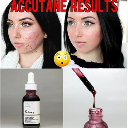 💖Peeling The Ordinary®🩸 AHA 30% BHA 2% 30ml