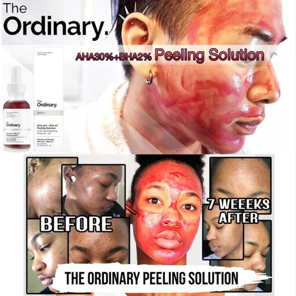 💖Peeling The Ordinary®🩸 AHA 30% BHA 2% 30ml