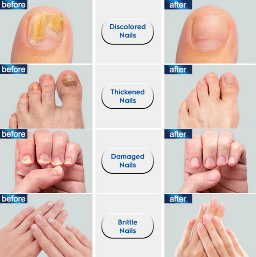 👋🦠Anti Hongos Uñas - German Toenail Plus™  2UND 30ml