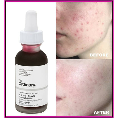 💖Peeling The Ordinary®🩸 AHA 30% BHA 2% 30ml